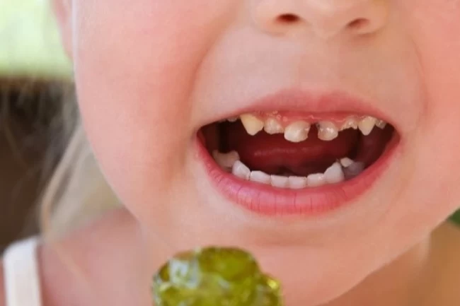 Okul çağındaki çocuklarda çürük riskine dikkat! Paketli gıdalar çocuk dişlerini vuruyor!