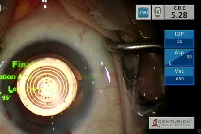 Canlı yayında göz ameliyatı yaptılar