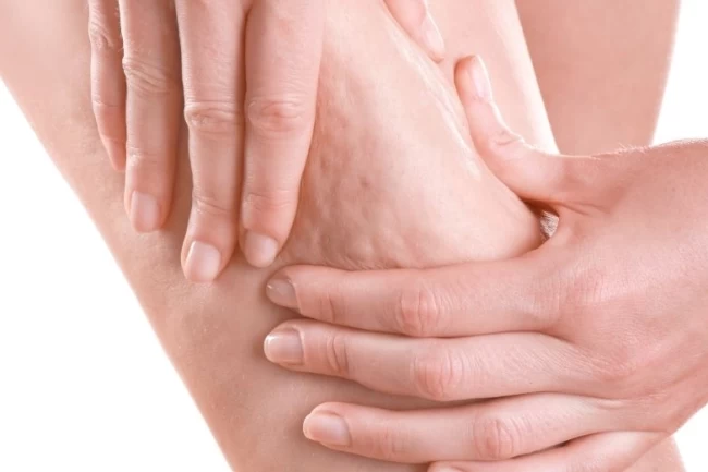 Prof. Dr. Karacalar'dan selülit uyarısı: Portakal kabuğu görüntüsü basit sorun değil!