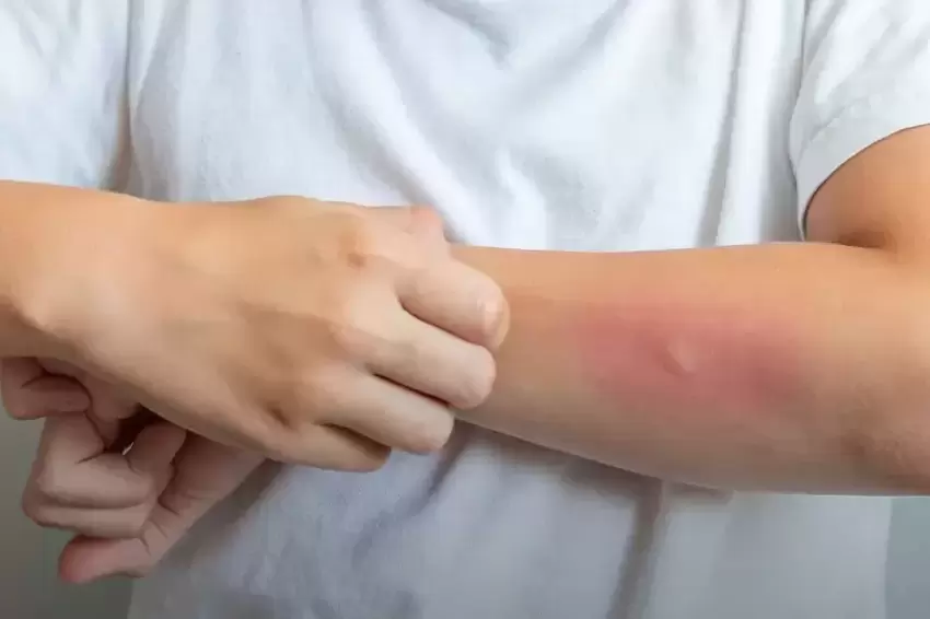 Egzama yalnızca cildi değil, sosyal yaşamı da etkileyebiliyor