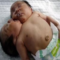 Çin'de iki başlı kız bebek doğdu